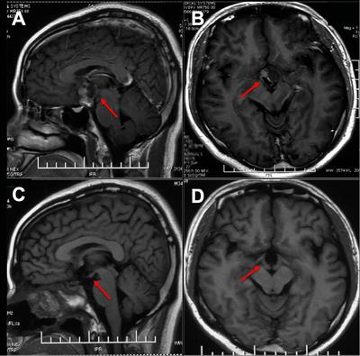 Advances in the treatment of Adamantinomatous craniopharyngioma: How to balance tumor control and quality of life in the current environment: a narrative review